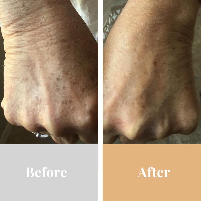 Omnilux Contour Glove, before and after