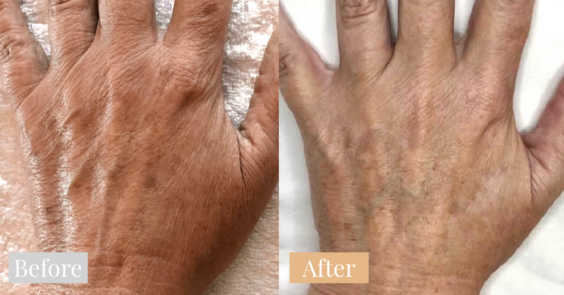 before and after Omnilux Contour Glove