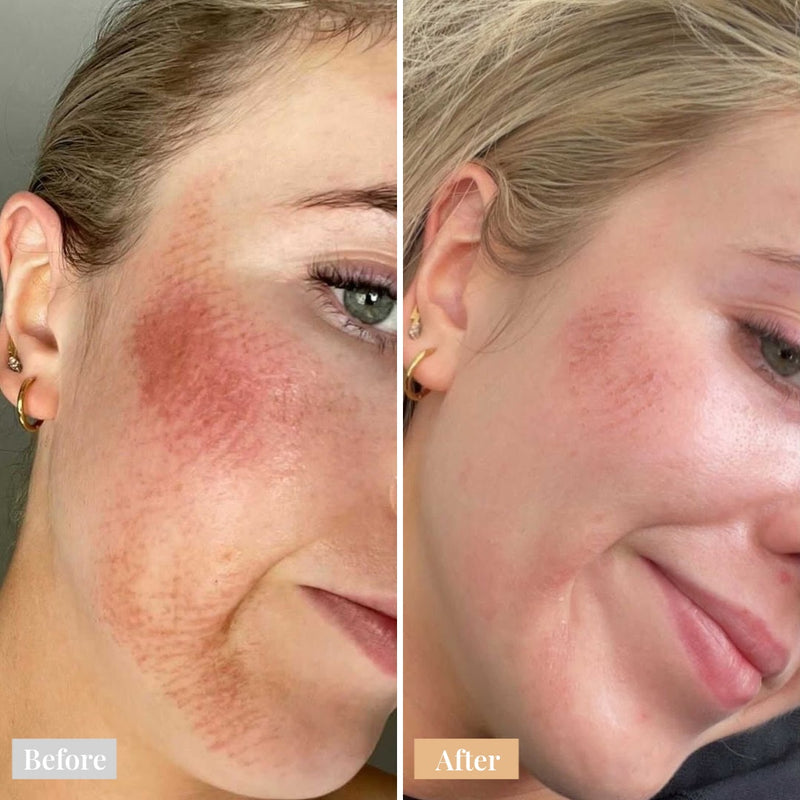 Before And After Omnilux Contour Face